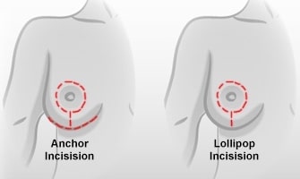 breast-reduction-incisions