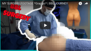 Karlee Steel's BBL Surgery Footage