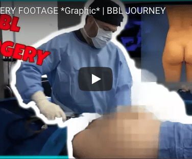 Karlee Steel's BBL Surgery Footage