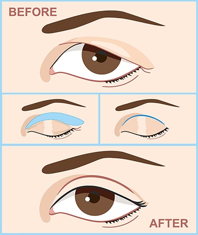 Blepharoplasty