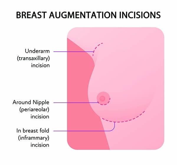 breast augmentation incisions