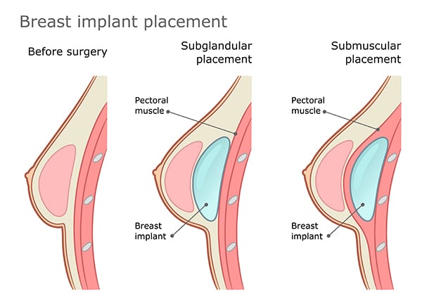 Breast implant placement