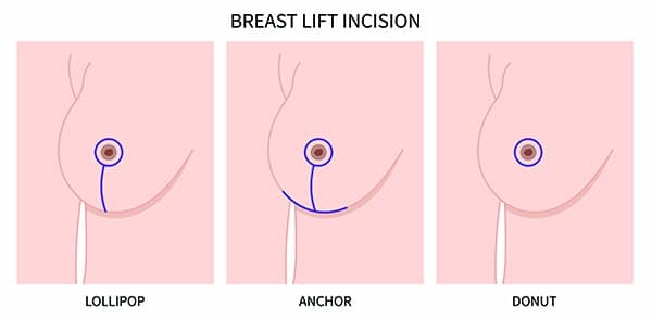 breast-lift-surgery