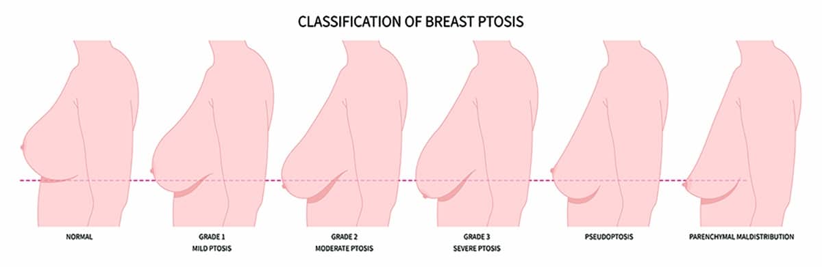 breast-ptosis