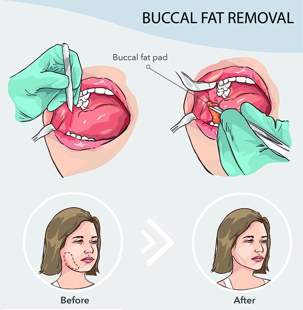 buccal fat removal