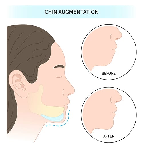 chin augmentation