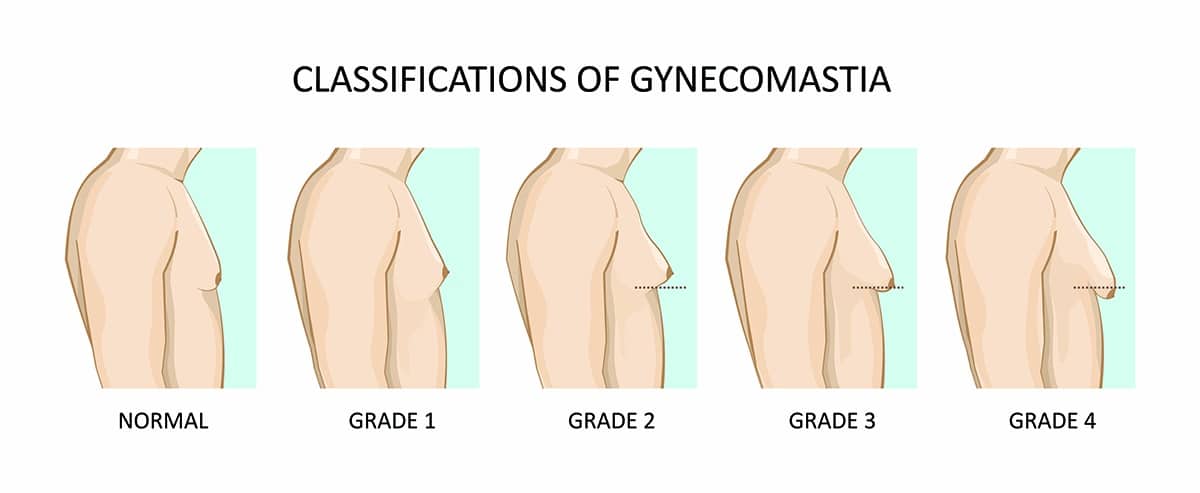 gynecomastia classifications