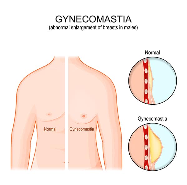 gynecomastia