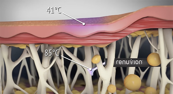 j-plasma skin tightening