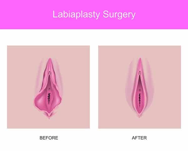 labiaplasty