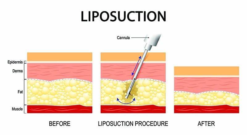 liposuction-surgery