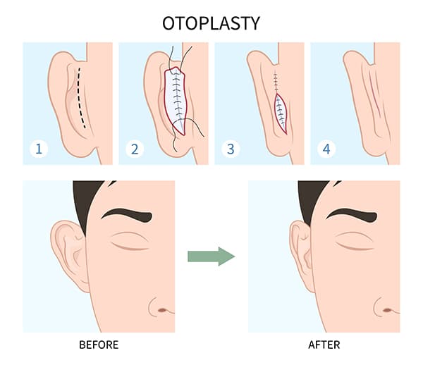 otoplasty