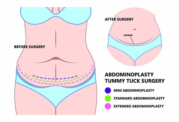 tummy tuck surgery