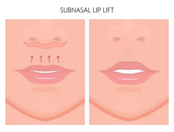 upper lip lift