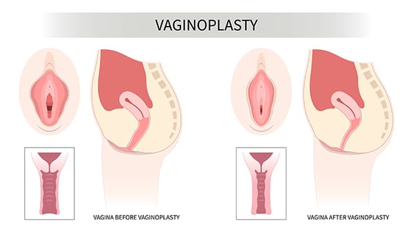 vaginoplasty