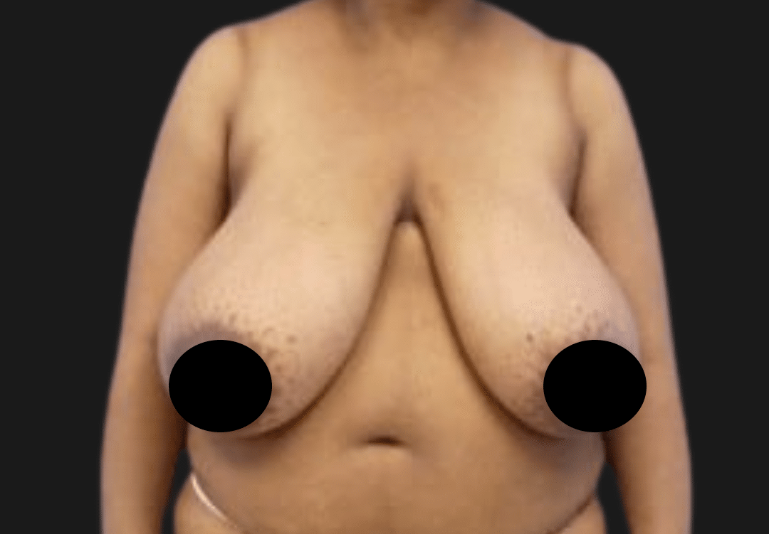 Front view of an adult woman's torso with large, sagging breasts; nipples are covered by black circles for modesty.
