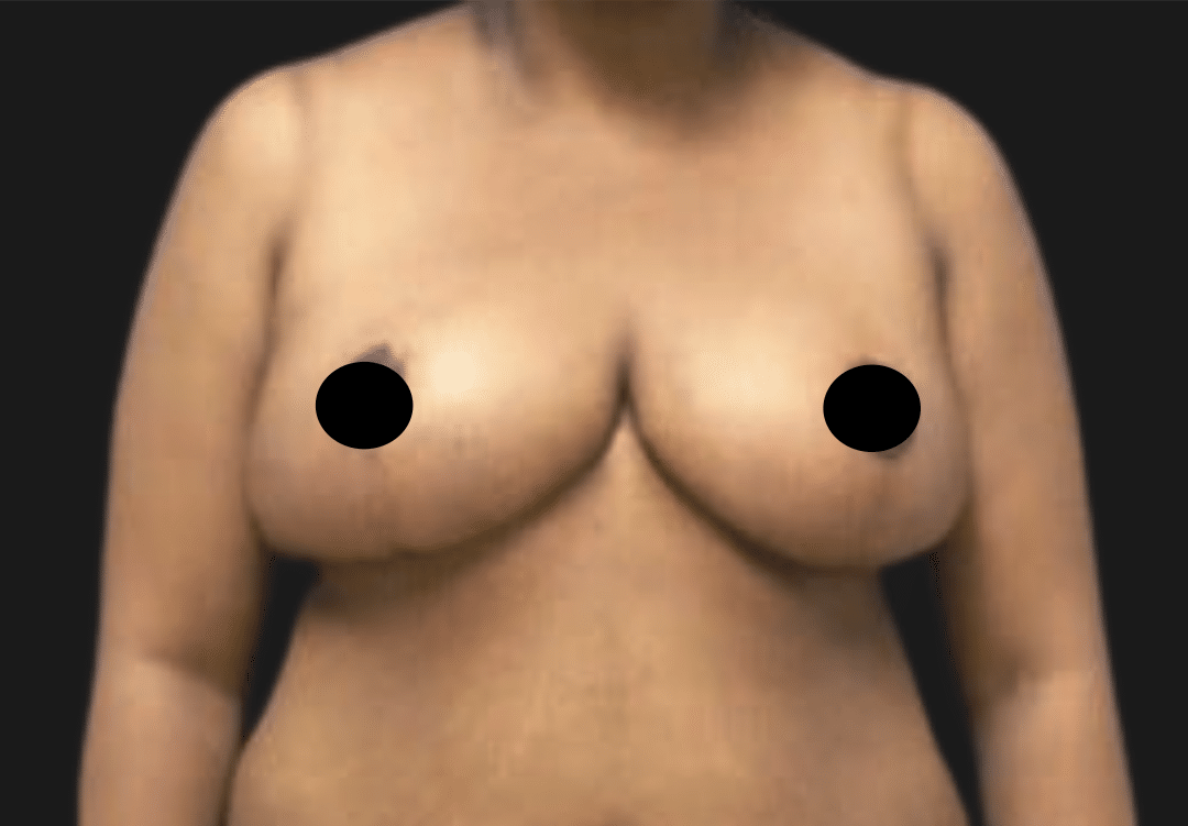 Front view of a topless adult woman with nipples obscured by black circles for privacy and anatomy demonstration.
