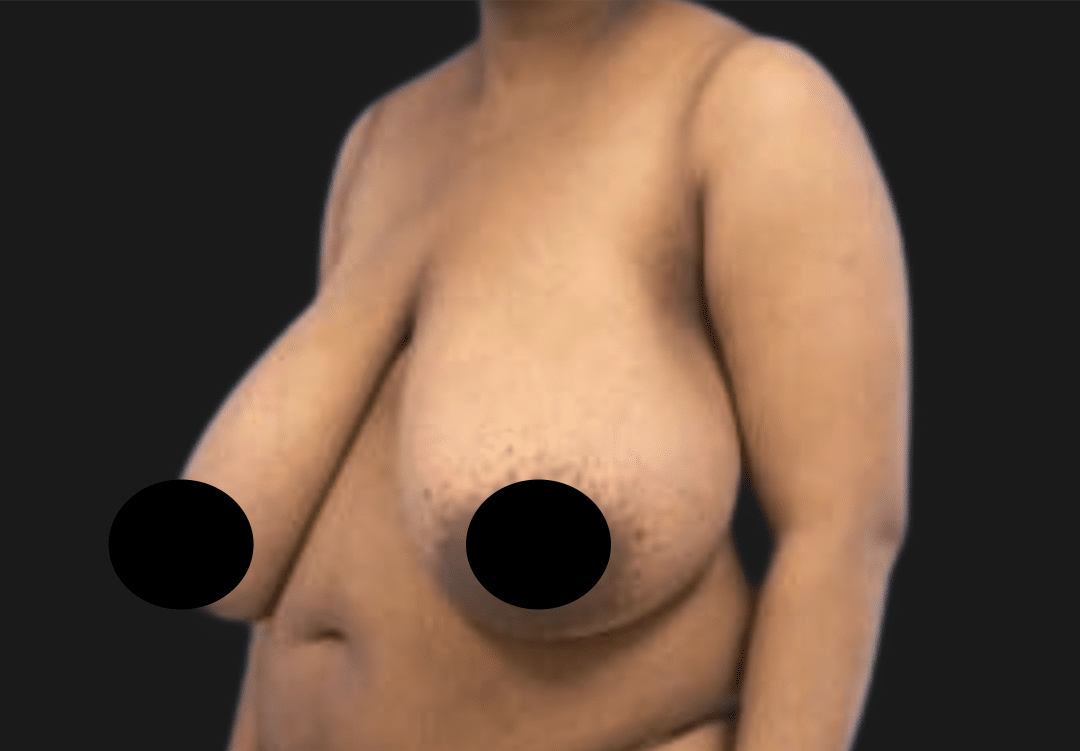 Side view of a topless adult female torso showing sagging breasts; nipples obscured with black circles.