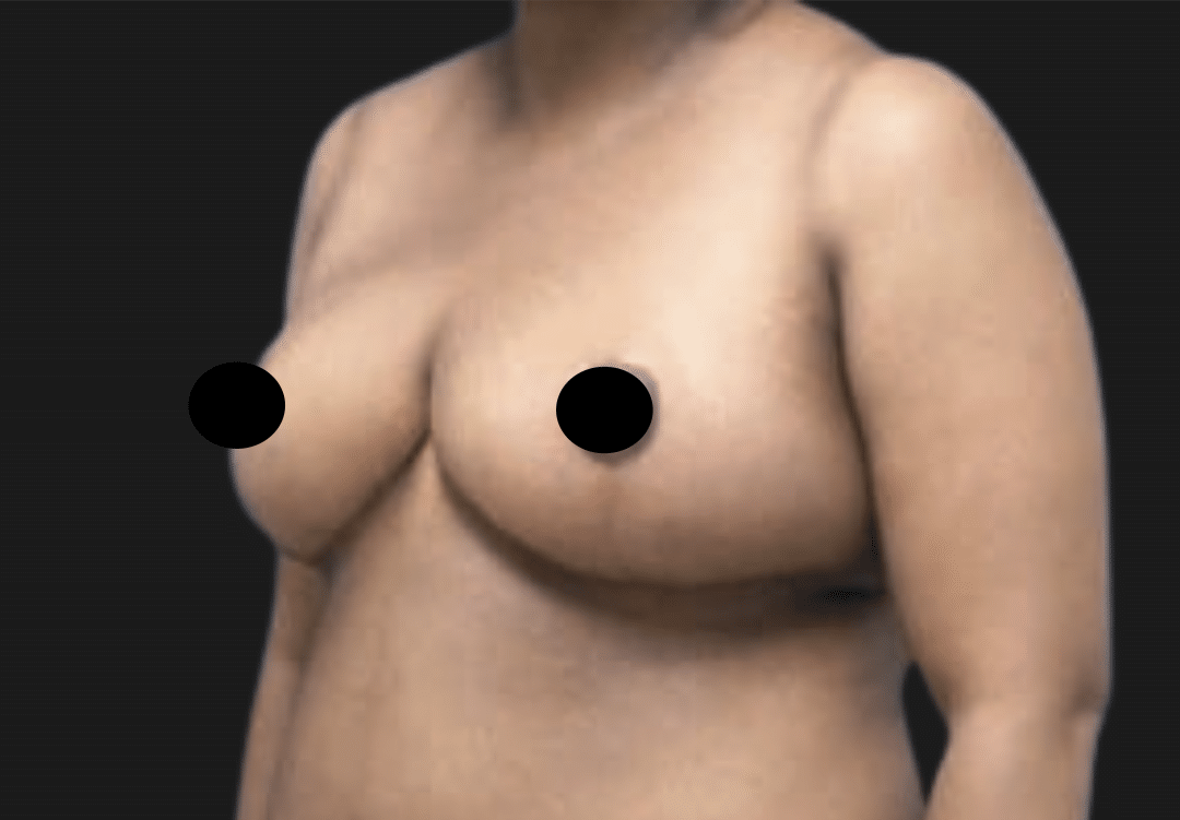 Torso of a topless adult woman facing left; breasts visible with nipples covered by black censor circles.
