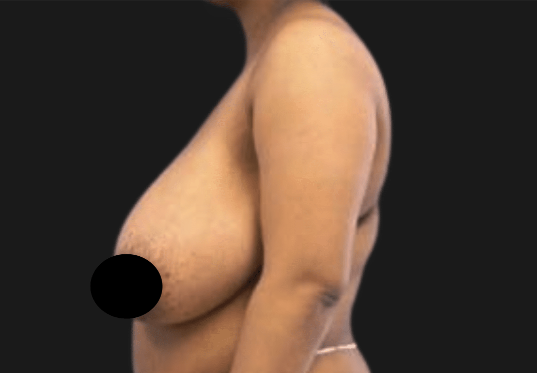 Side profile of a topless adult woman's torso with the left breast obscured by a black censor circle against a dark background, for medical/educational context.