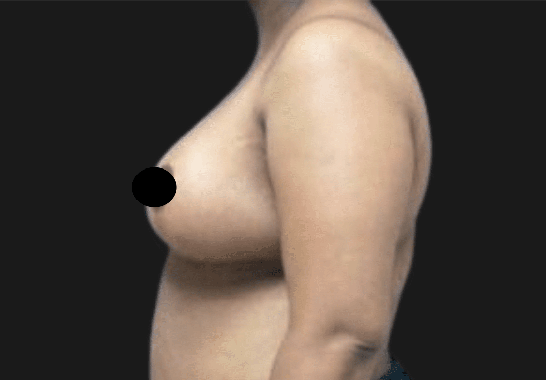 Side view of a topless adult's upper body with the nipple obscured by a black dot; profile shot for medical assessment.