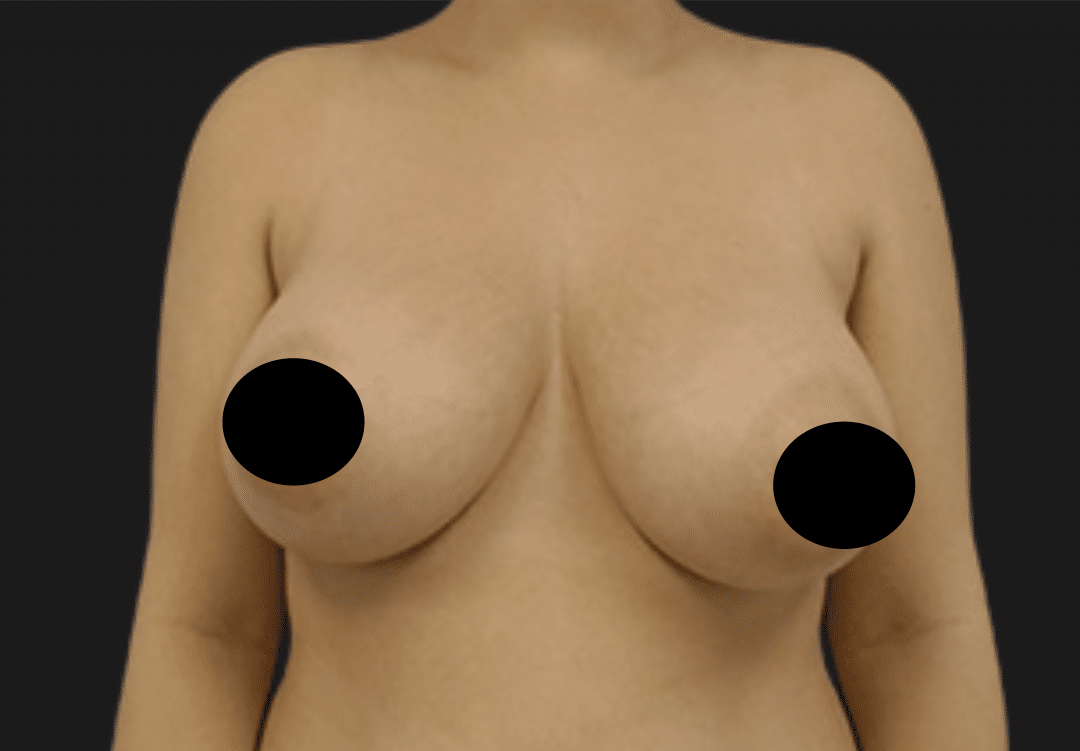 Front view of an adult woman's torso with breasts exposed (nipples obscured by black circles) for privacy.