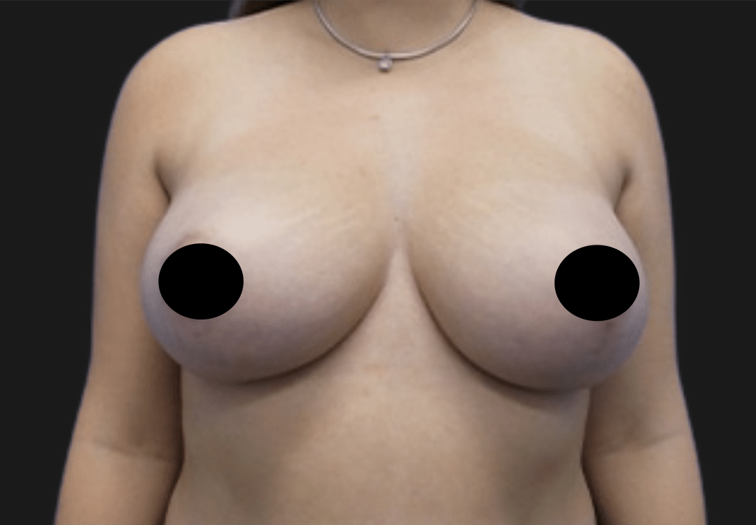 Front view of a topless adult woman with nipples obscured by black circles for privacy.