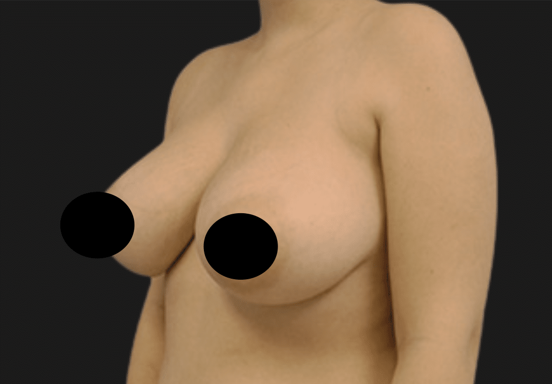 Side-view of a topless adult woman's torso with breasts partially covered by black censor circles, likely for medical or cosmetic assessment.