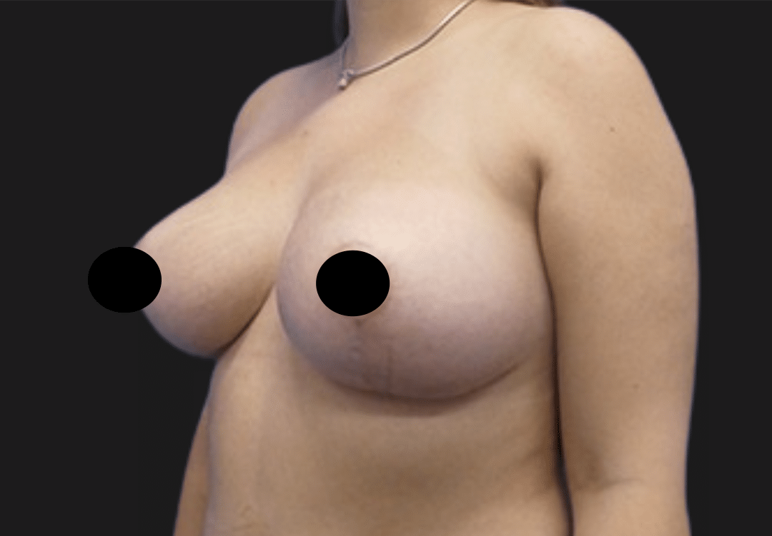 Side view of a topless adult woman's chest and upper torso, with nipples covered for privacy.