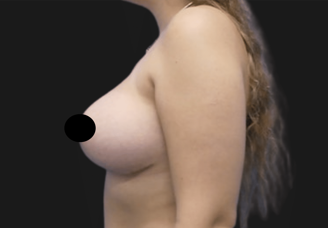 Profile view of a topless woman's torso from shoulder to midriff; breast area obscured by a black censor circle for privacy against a dark background.