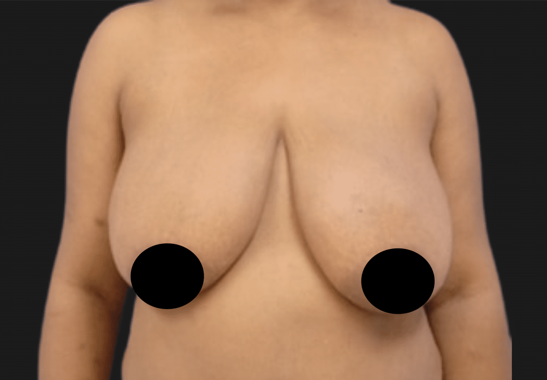 Front view of a topless adult female chest showing sagging breasts with nipples covered for privacy.