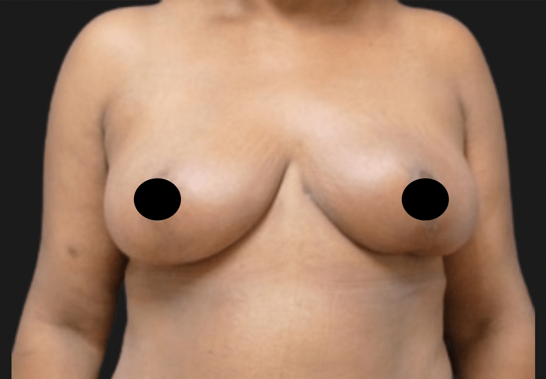 Front view of an adult woman's bare chest with nipples censored by black circles against a dark background (medical/photo context).
