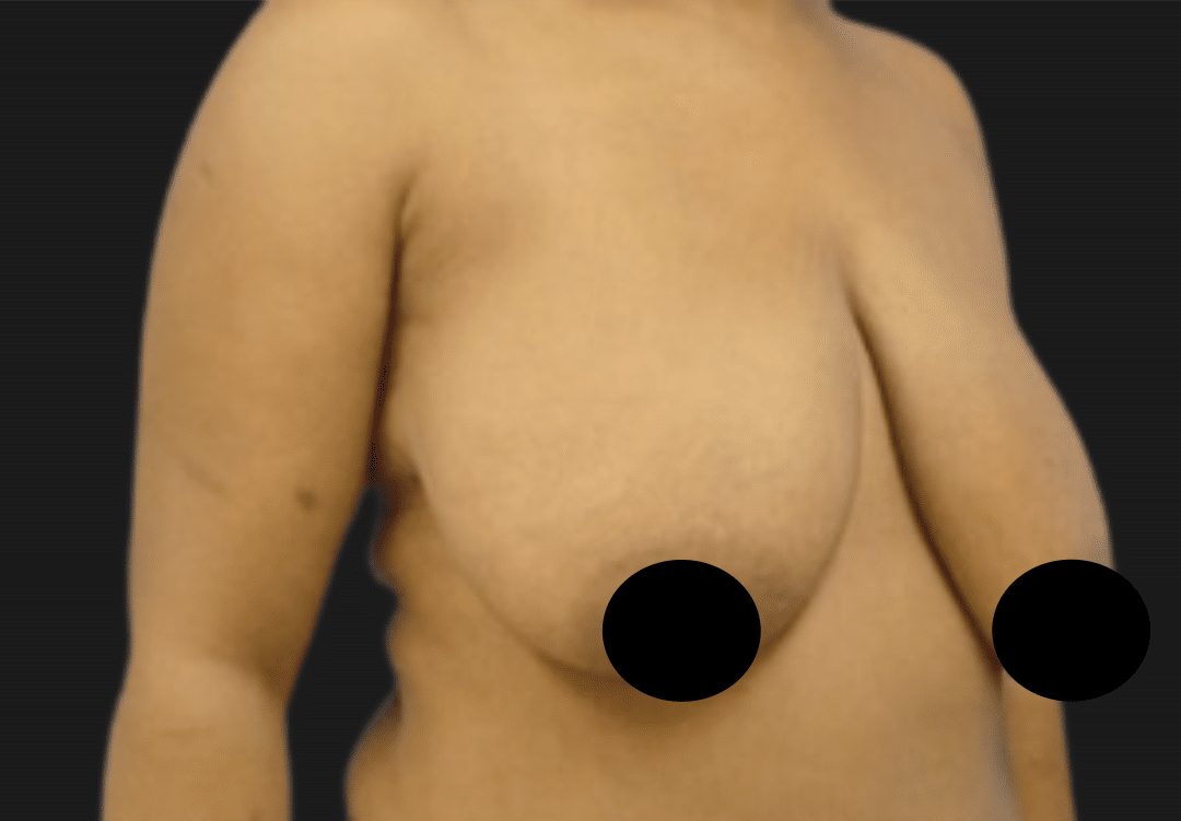 Side view of a topless adult showing moderate breast ptosis with the left breast lower than the right; nipples are covered for privacy.