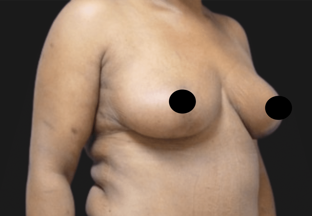 Side view of a topless woman's torso with breasts visible; nipples obscured by black circles for privacy/containing sensitive content.