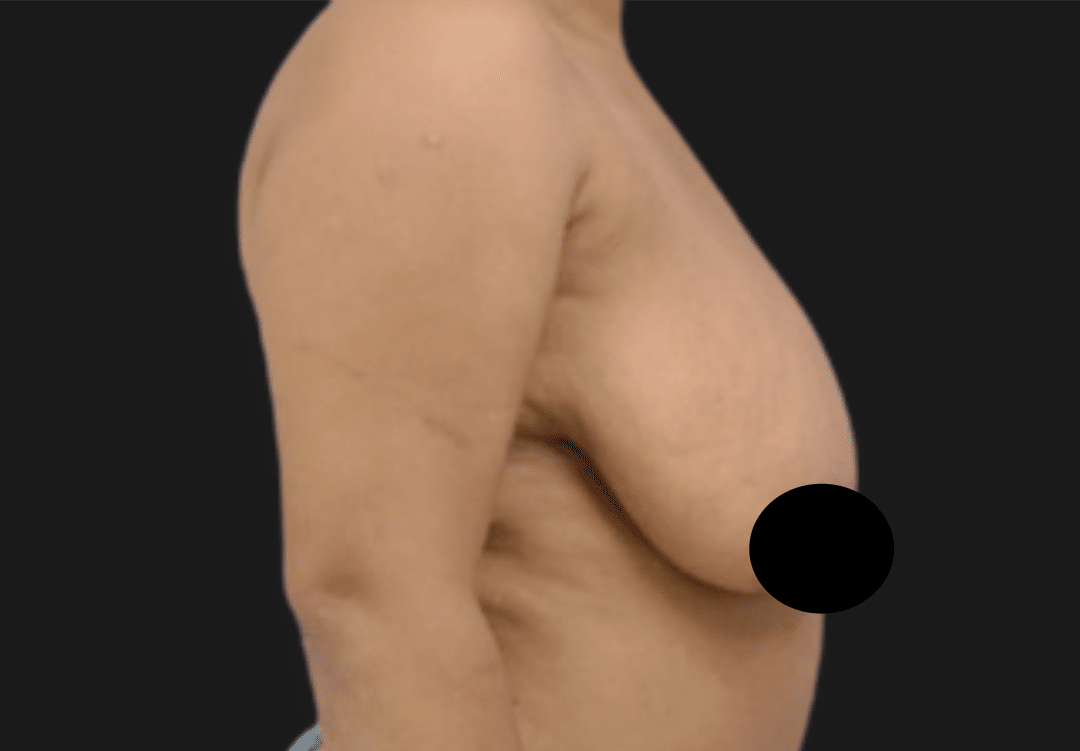 Profile view of a woman's torso showing a sagging breast with the nipple area censored by a black circle.