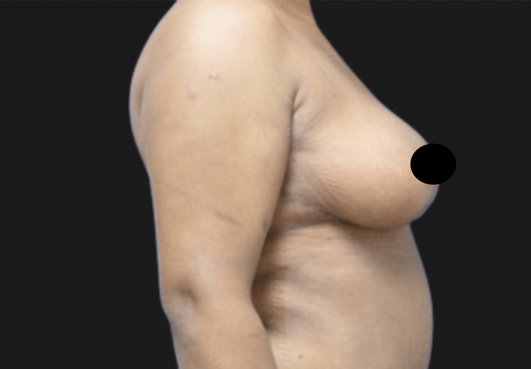 Left-side profile of a topless woman’s upper body with the breast visible and nipple obscured by a black dot.