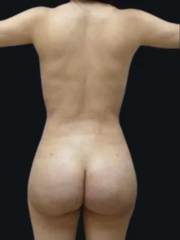 Brazilian butt lift after surgery with Dr. Salama, case 1002, back view