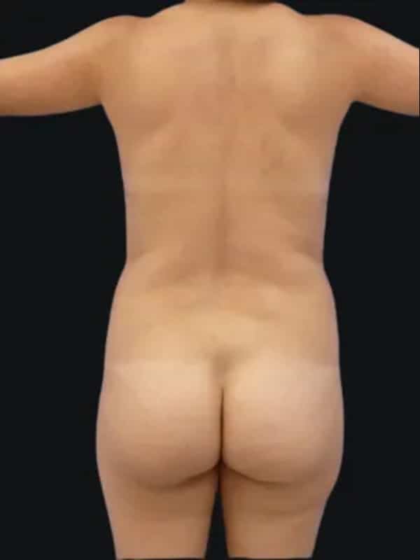 Brazilian butt lift before surgery with Dr. Salama, case 1002, back view