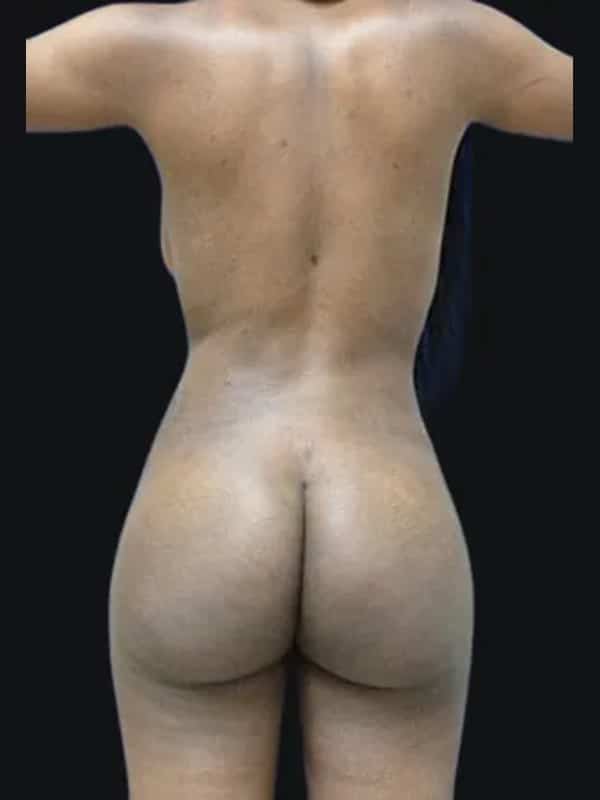 Brazilian butt lift after surgery with Dr. Salama, case 1011, back view