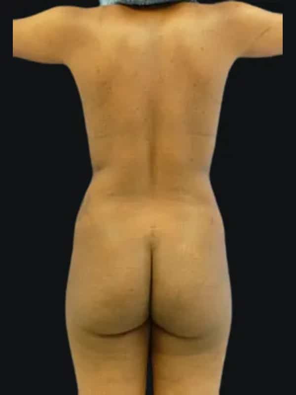 Brazilian butt lift before surgery with Dr. Salama, case 1011, back view