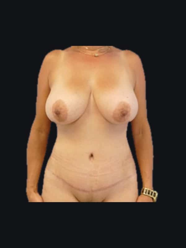 Tummy tuck after surgery with Dr. Salama, case 1111, front view