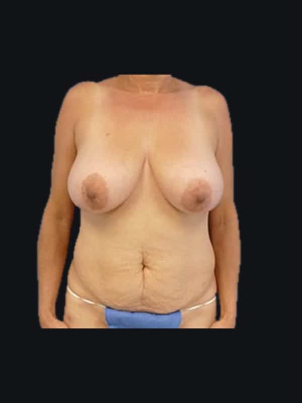 Tummy tuck before surgery with Dr. Salama, case 1111, front view