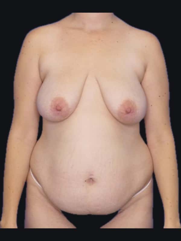 Tummy tuck before surgery with Dr. Salama, case 1152, front view