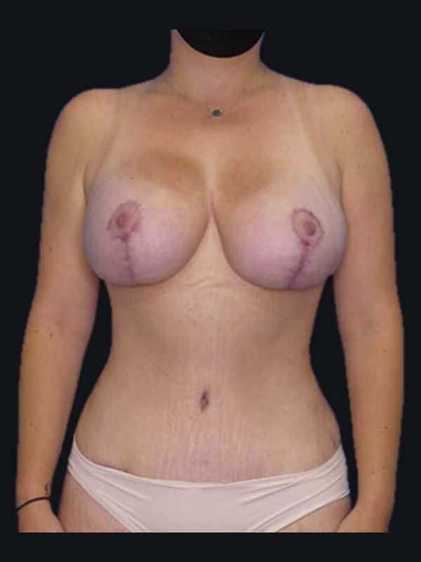 Mommy makeover after surgery with Dr. Salama, case 1167, front view