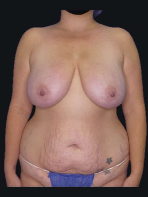 Mommy makeover before surgery with Dr. Salama, case 1167, front view