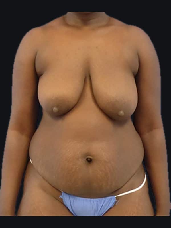 Mommy makeover before surgery with Dr. Salama, case 1198, front view
