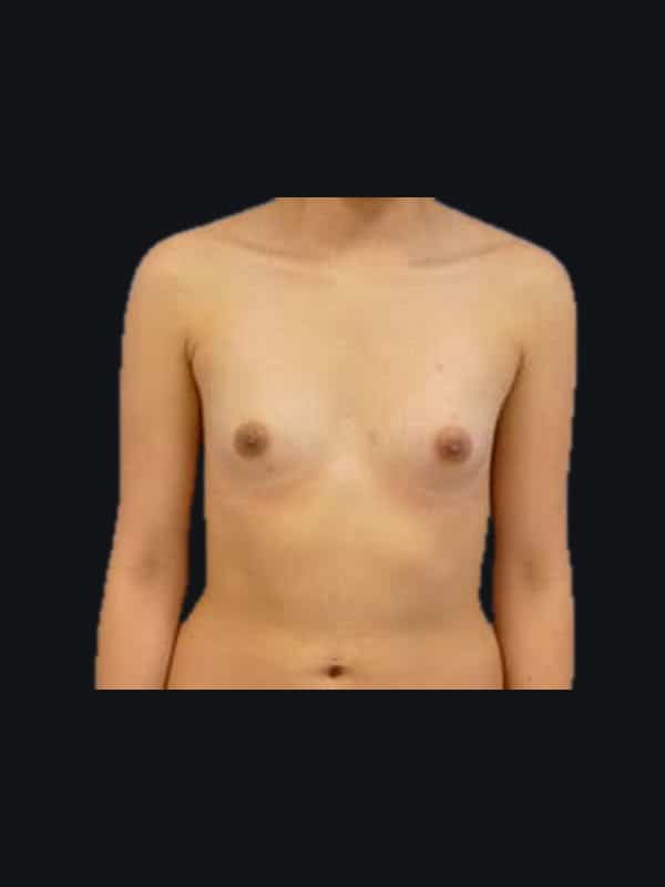 Breast augmentation before surgery with Dr. Salama, case 1219, front view