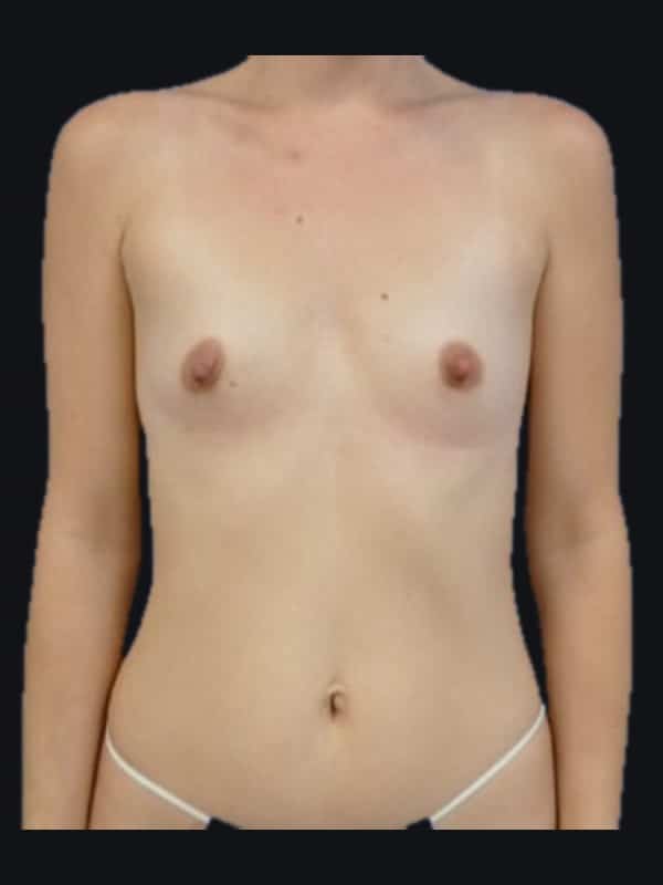 Breast augmentation before surgery with Dr. Salama, case 1220, front view