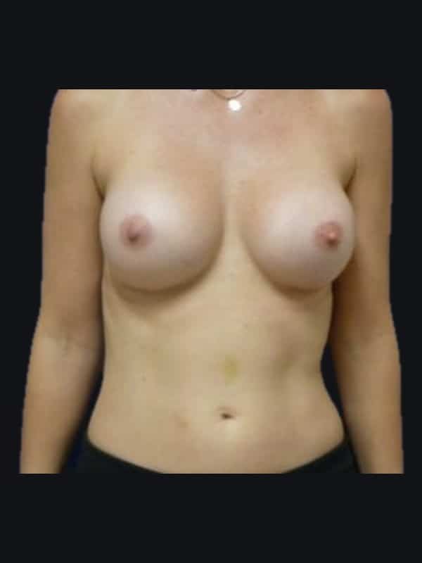 Breast augmentation after surgery with Dr. Salama, case 1222, front view