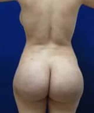 Brazilian Butt Lift after, case 1022, back view (Female, 24: BBL (900 cc per side))